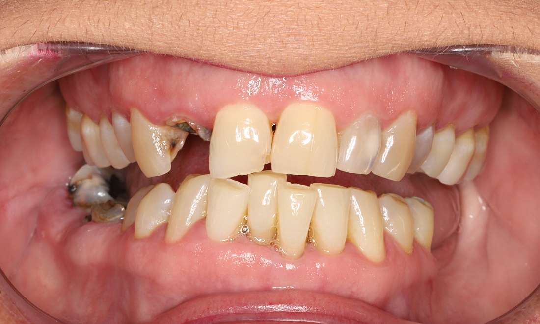 Before treatment, multiple decayed, chipped, missing teeth