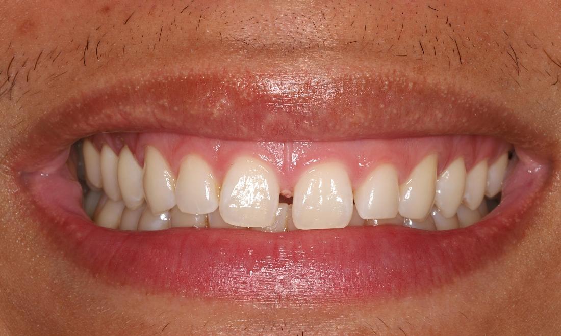 Before treatment, gaps between the upper front teeth