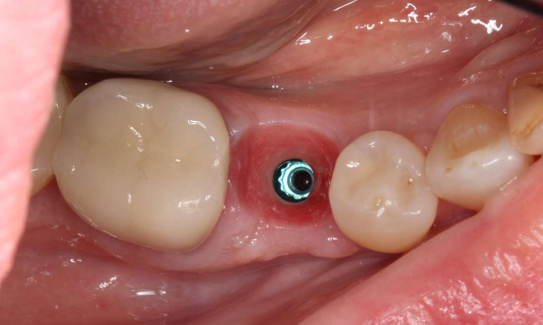 During treatment, after shaping soft tissue with a custom temporary implant crown