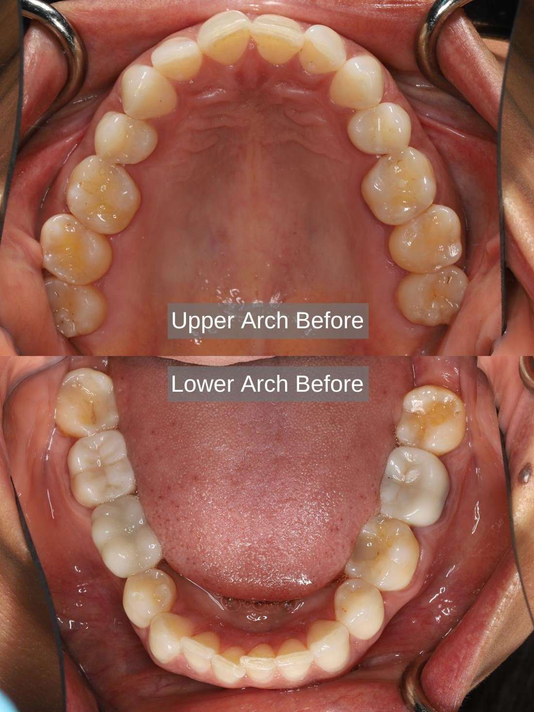 Before Aligners, Bleaching, Composite Bonding