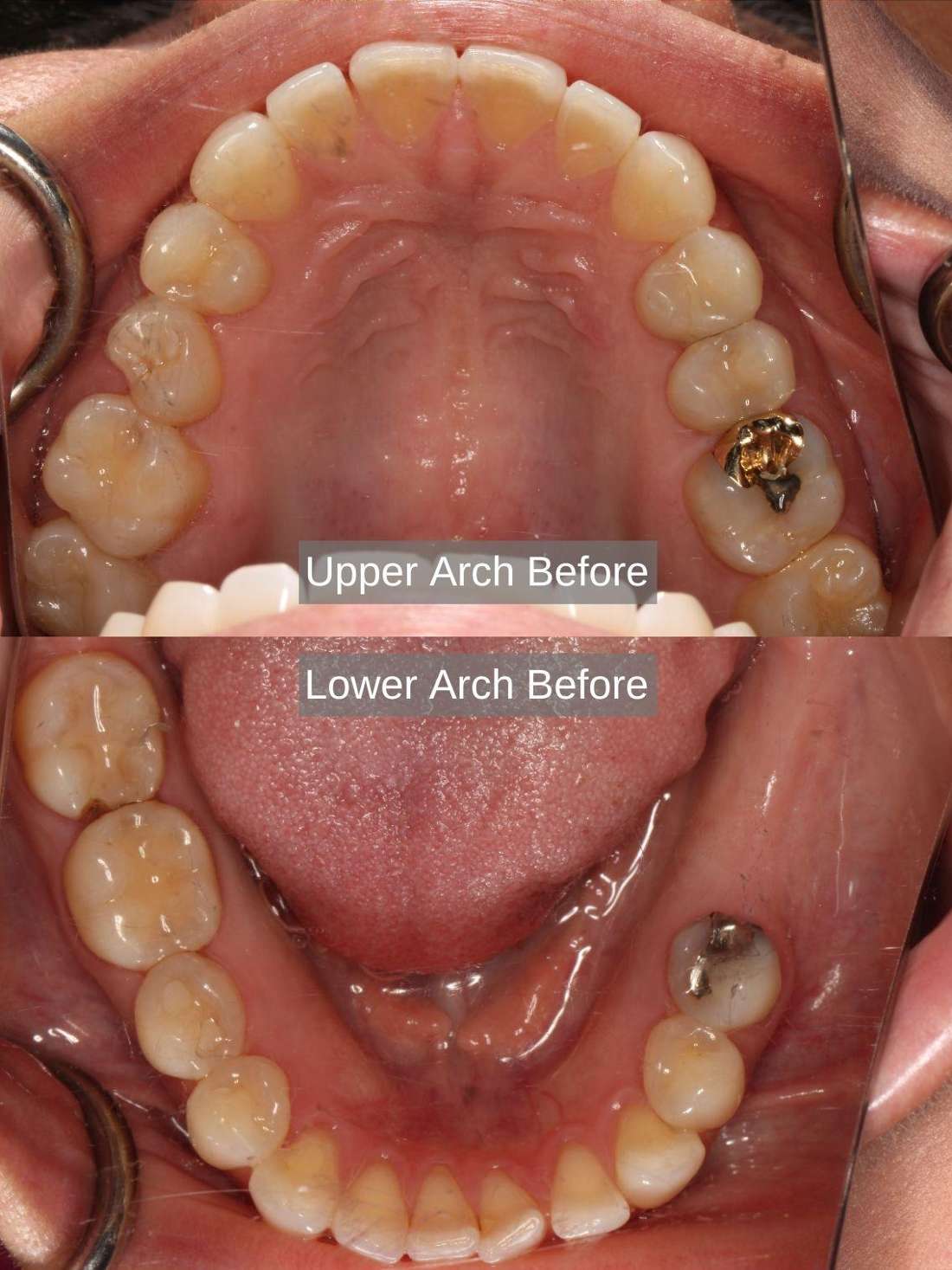 Before treatment, spaces between teeth, multiple teeth with cavities, missing teeth