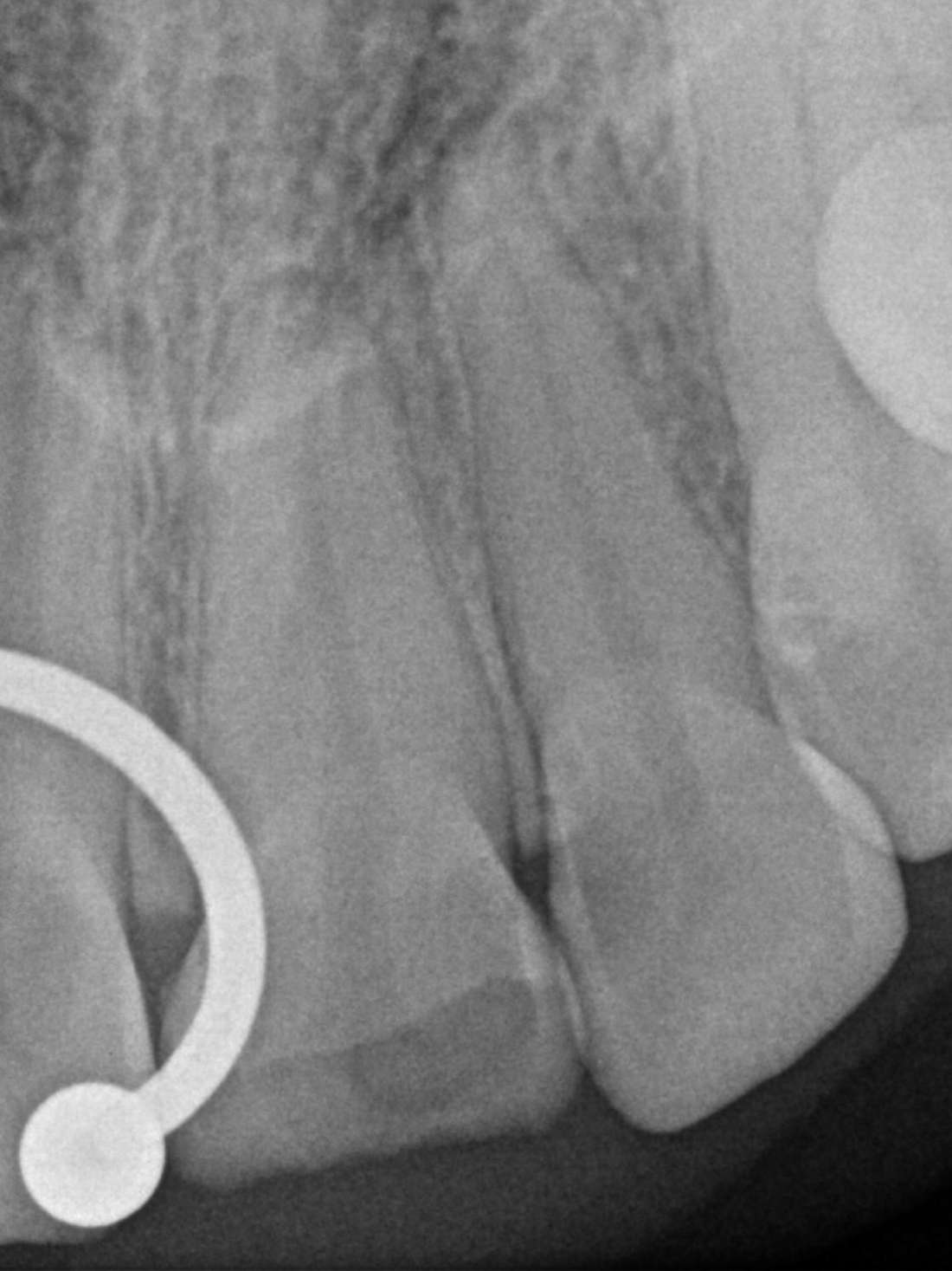 x-ray of fractured tooth