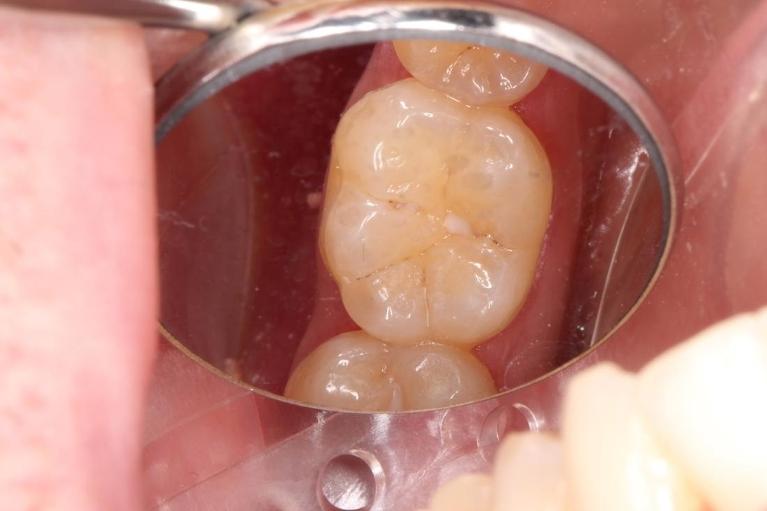 Cavity-After-Image