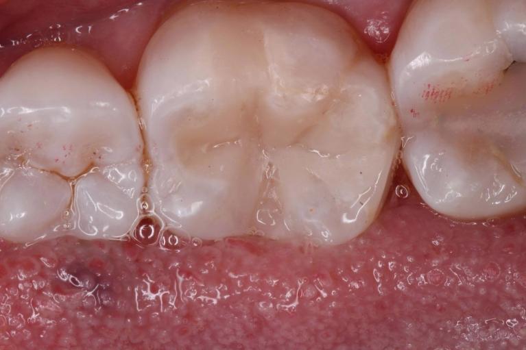 White composite filling, tooth colored filling | humble dental fillings