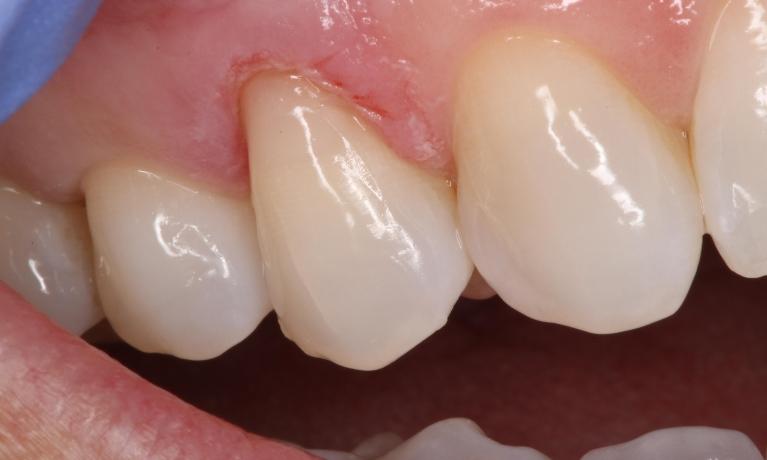 a tooth who has had an old filling removed and replaced | humble tx dental fillings