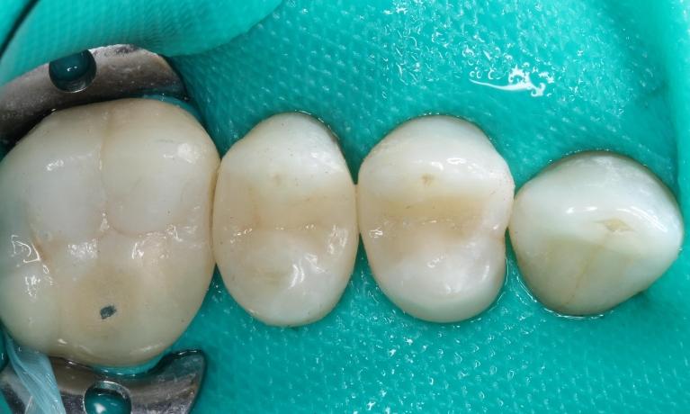 molars after having gaps between them filled | humble dentist