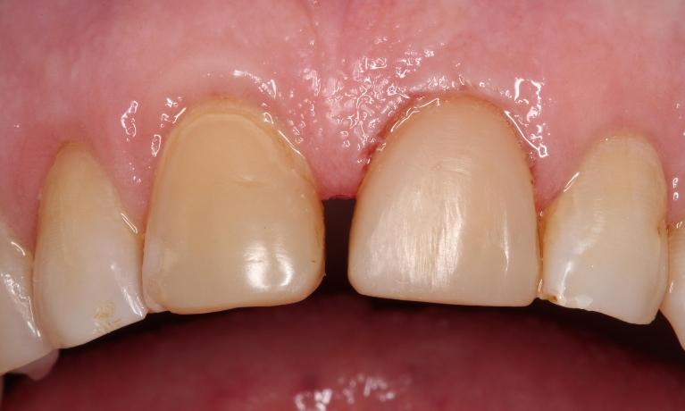 a front tooth with a veneer on it, repairing the chip | humble tx dental veneers