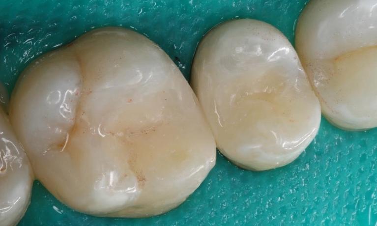 rear teeth after filling has been put between them | humble dentist