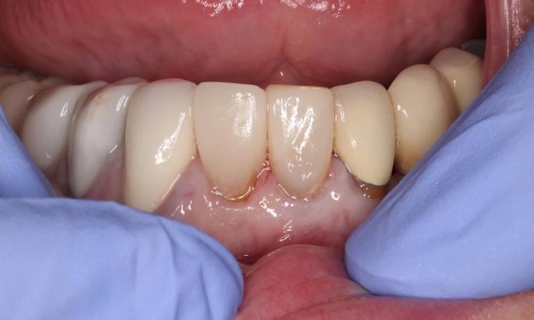 two dental veneers placed on the two lower teeth, brightening their appearance | veneer dentist humble tx