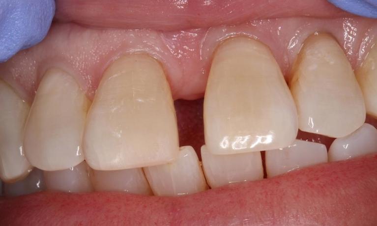 Tooth colored filling, repaired tooth, repaired tooth colored filling | humble tx dental fillings