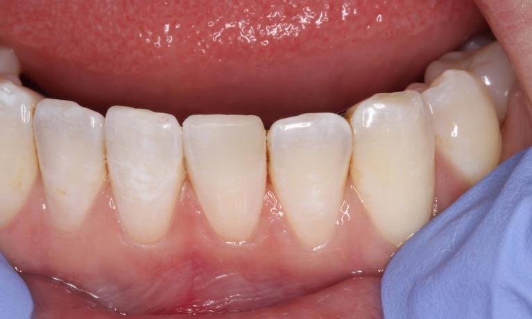 a tooth with a chip repaired | humble tx cosmetic dentist