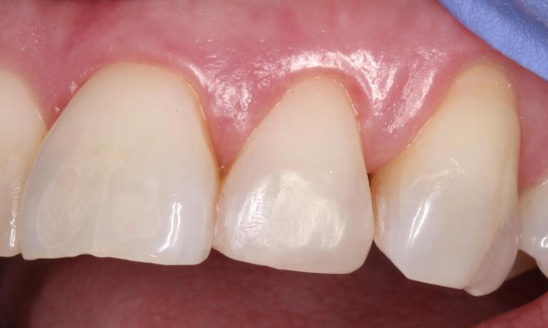 a chipped tooth repaired with composite resin | humble tx cosmetic dentist