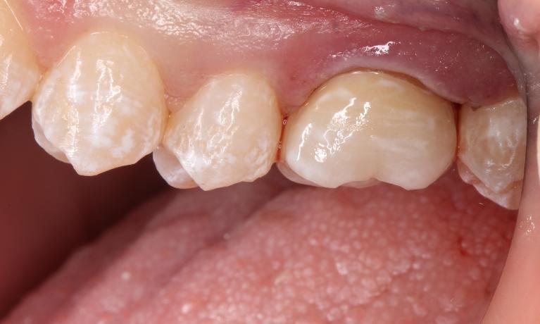 a smile with a new, natural looking crown | humble dental crowns