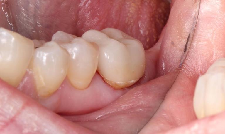 permanent crown, crown bonded in place, all ceramic crown | humble tx dental crowns