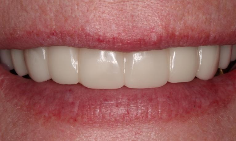 a smile after snap-on-smile, featuring uniform teeth | dentist