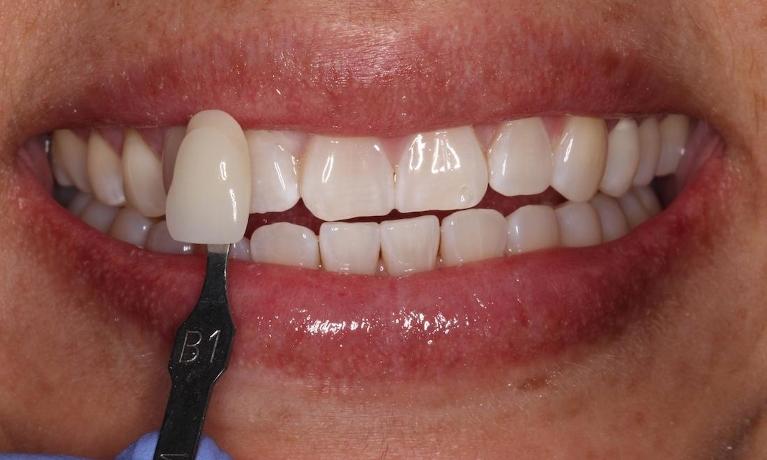 a smile, brighter after teeth whitening | teeth whitening in humble tx
