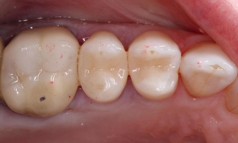 molars with dental fillings between them | humble tx filling dentist