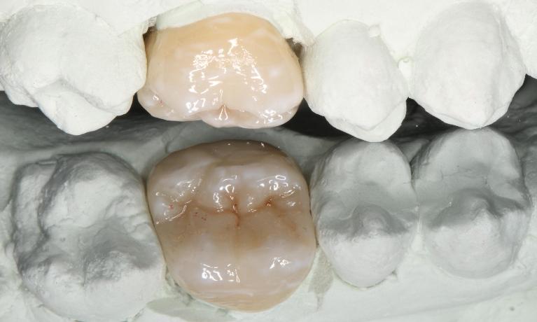 a crown, crafted into a mold of a person's mouth | dental crowns in humble tx
