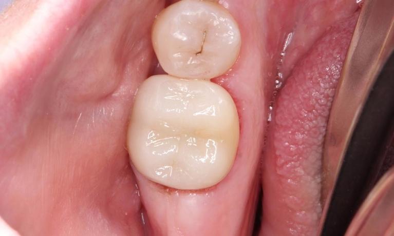 cosmetic crown, all ceramic crown, crown bonded in place, permanent crown | humble dental crowns