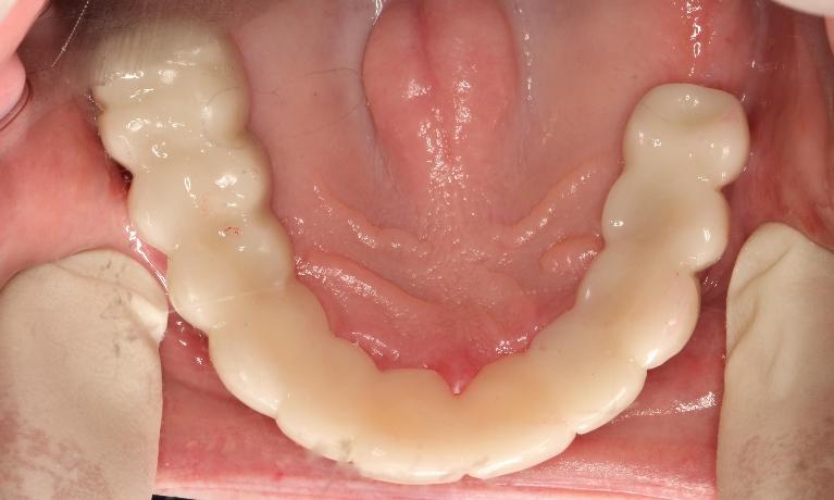 a bottom-up view after snap on smile | humble snap on smiles