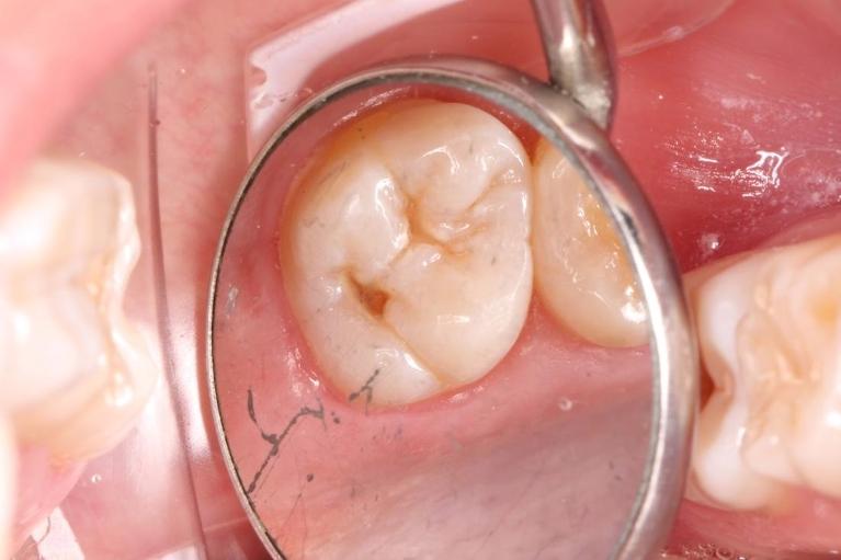 Cavity-Before-Image