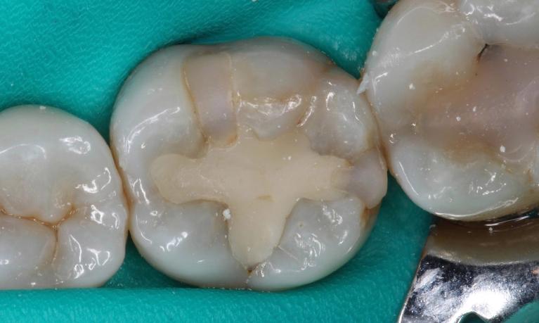 old filling, leaking filling, recurrent decay, open margins on filling | dental fillings humble tx