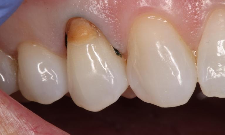 an old filling with decay and discoloration | dental fillings humble tx