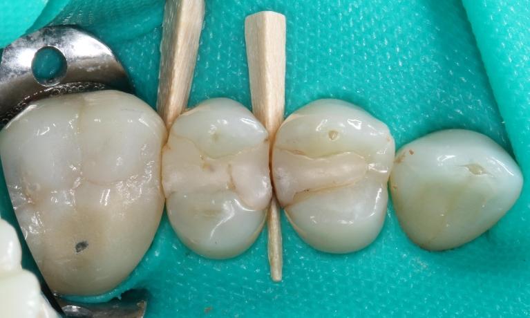 molars before composite fillings | dentist in humble tx