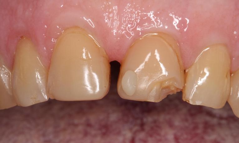 a front tooth with a chip | veneers humble tx