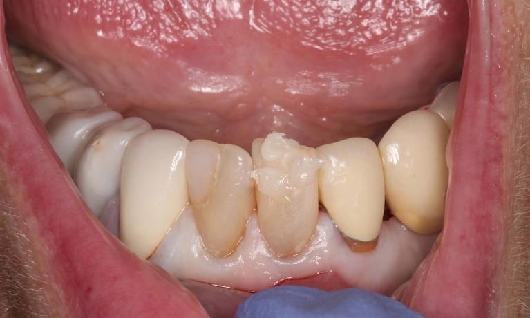 darkened, lower front teeth | dental veneers humble tx