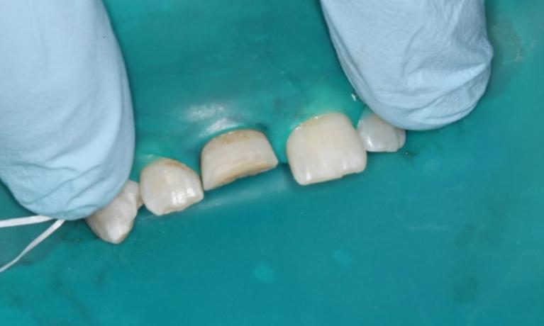 Dental dam, chipped tooth, dental emergency, dental trauma | dentist in humble tx