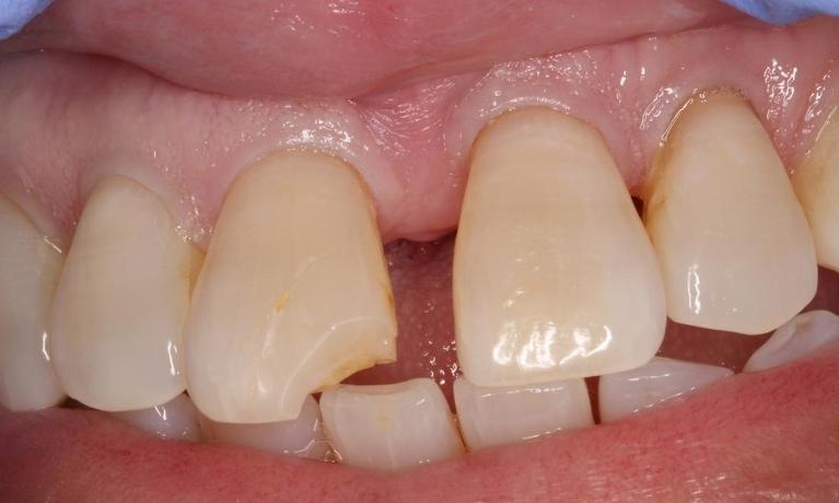 Chipped tooth, chipped filling, broken tooth colored filling | tooth colored fillings humble tx
