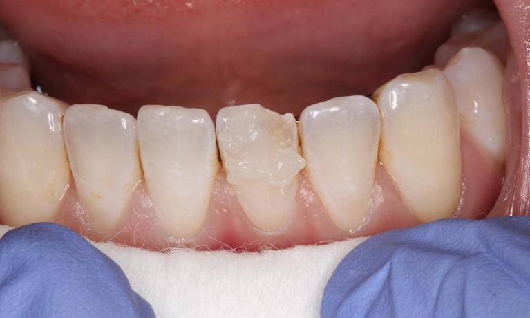 a chipped bottom tooth | cosmetic dentist humble