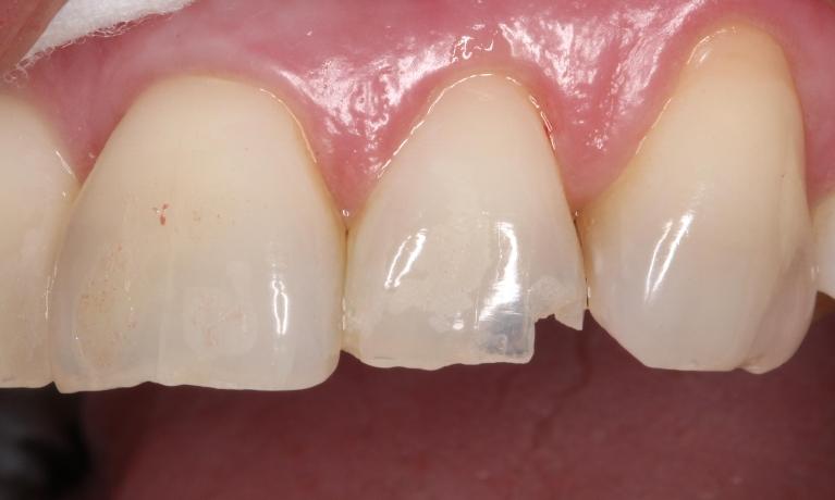 a chipped tooth | cosmetic dentist humble