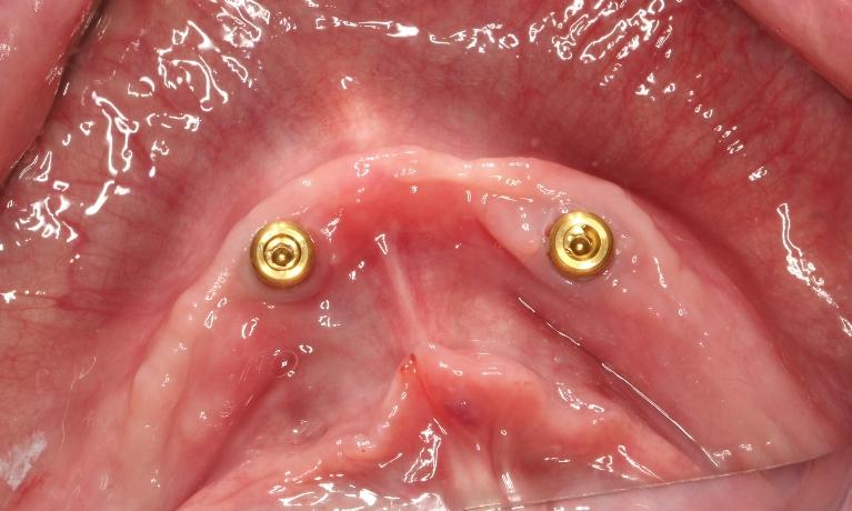 Implant-Retained-Overdenture-Before-Image