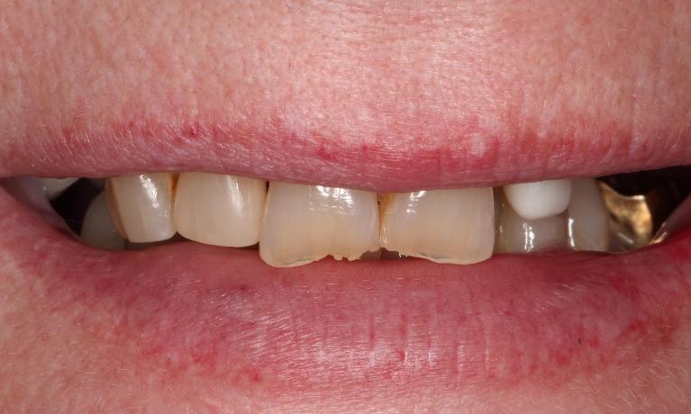 a smile before snap on smile, with chips, discolorations, misalignment, and a golden crown | snap-on-smile dentist humble