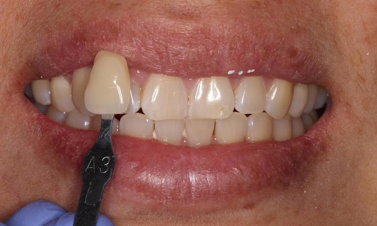 a smile before teeth whitening | humble tx teeth whitening