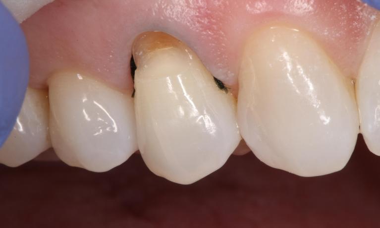 a tooth that has had an old filling removed, and is waiting to get it replaced | filling dentist in humble tx