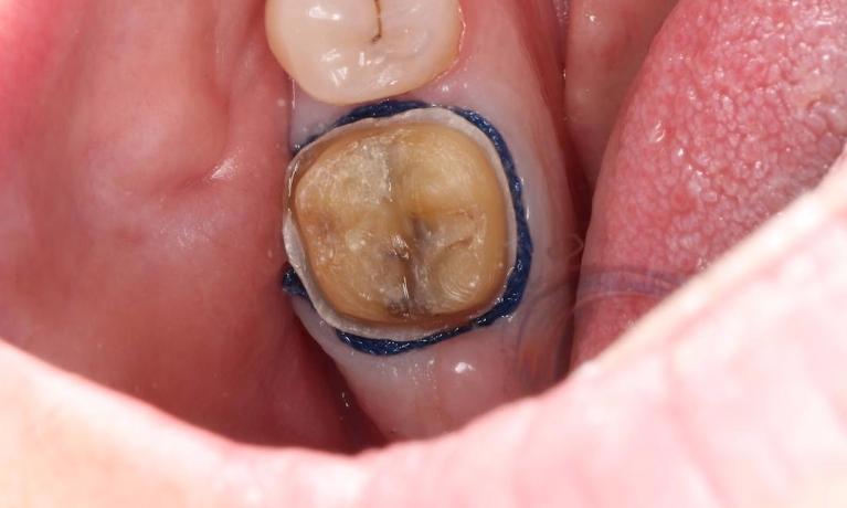 crown preparation, cracked tooth prepared for crown | crown dentist humble