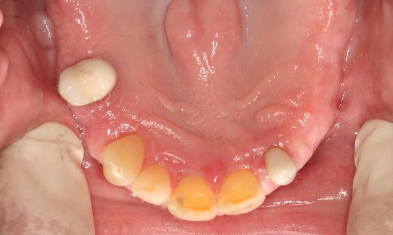 a bottom-up view of teeth before snap on smile | humble snap on smile dentist