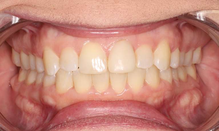 Clear-Aligners-Before-a-Crown-Replacement-After-Image