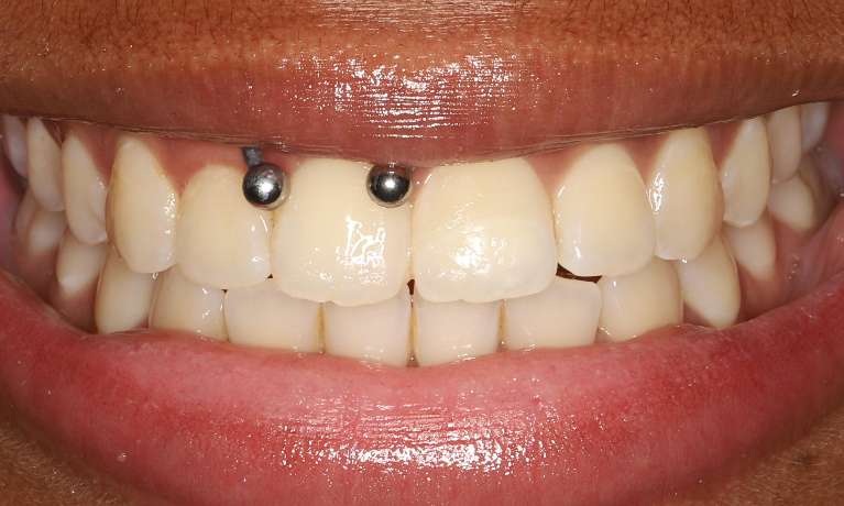 Tooth reattached