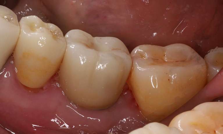 Replacing-a-Missing-Molar-with-a-Dental-Implant-After-Image