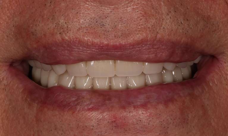 Upper-and-Lower-Implant-Retained-Overdentures-After-Image