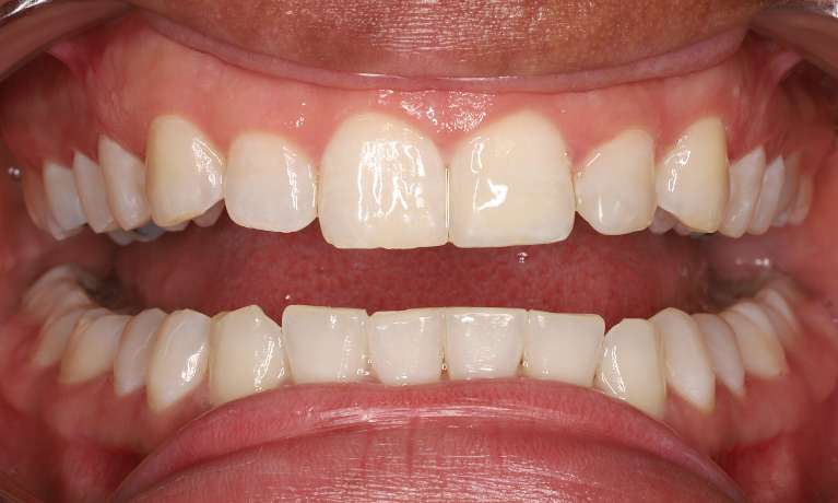 After treatment with direct composite veneers
