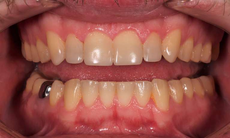 After treatment with direct composite veneers