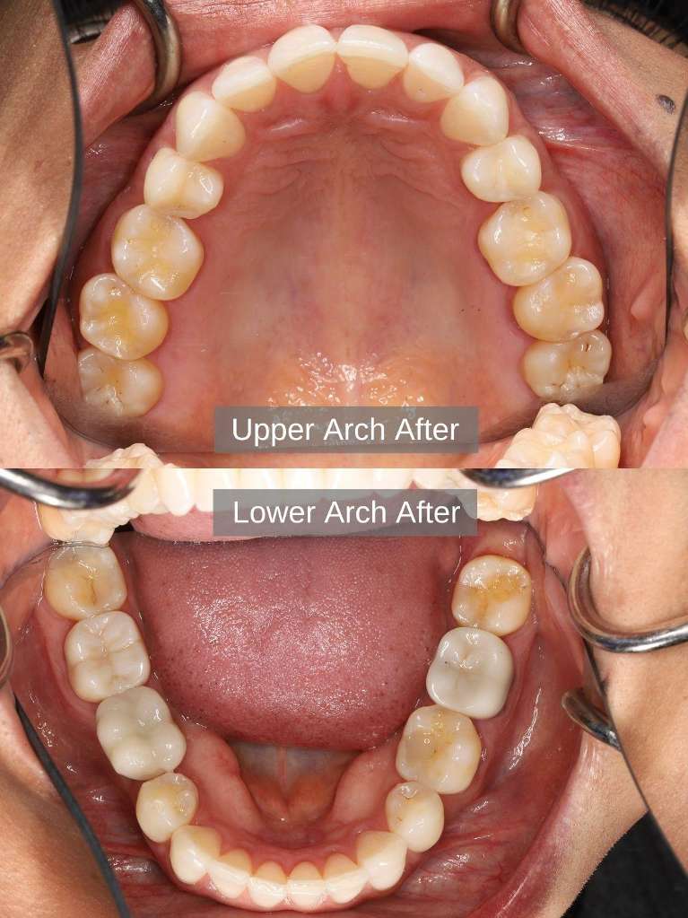 After Aligners, Bleaching, Composite Bonding