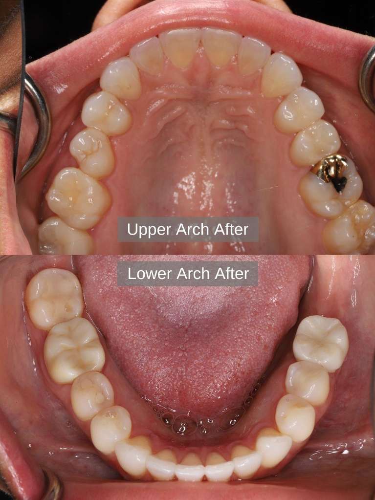 After treatment with direct composite fillings, crowns, dental implants, and Clear Correct Aligners