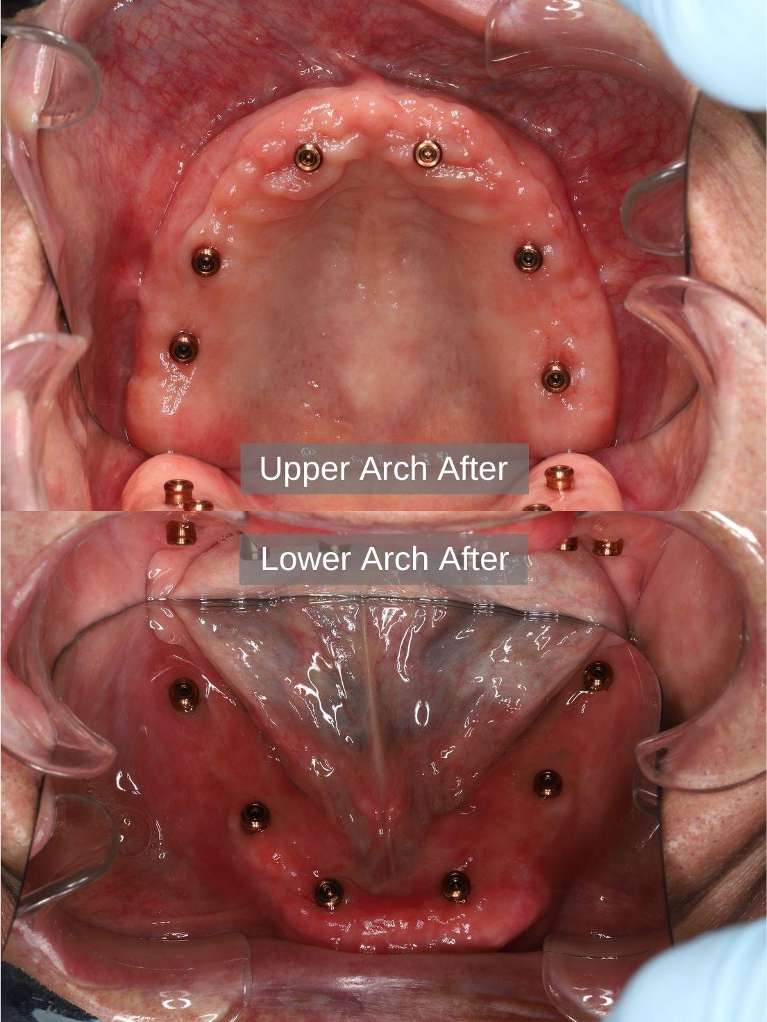 After treatment, 6 upper and 6 lower dental implants with locator abutments for implant retained overdentures