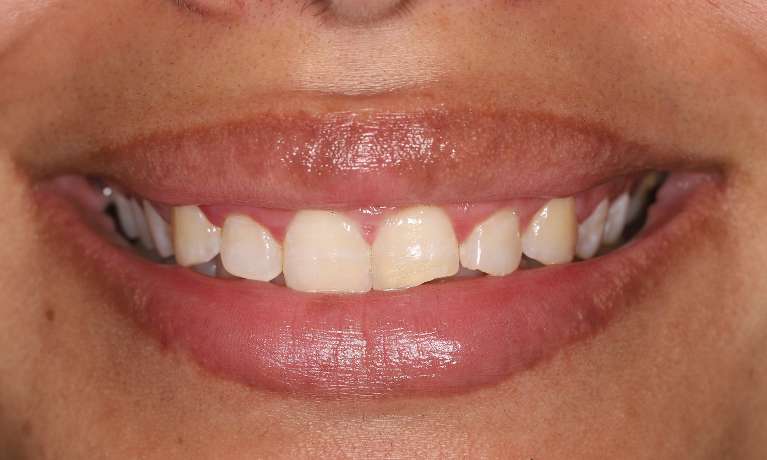 Before treatment, chipped teeth on upper left